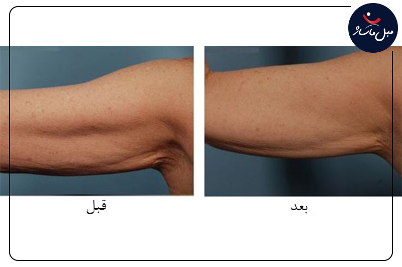 آموزش ماساژ سلولیت و بهترین تکنیک های درمان آن 3 درمان سلولیت با دستگاه exilis